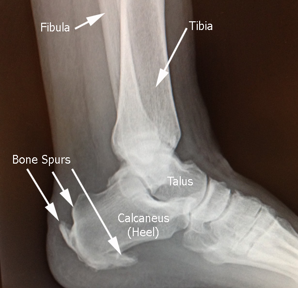 heel spur and achilles tendon surgery