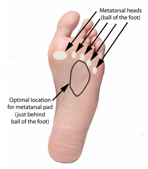 Morton s Neuroma Drwolgin