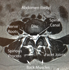 lumbar-normal-axial-mri-w-text – Drwolgin