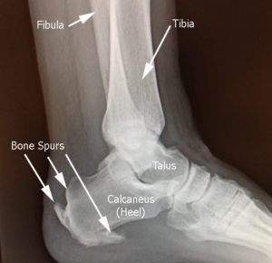 achilles-tendonitis-lat-xr-w-text2 – Drwolgin