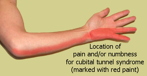 Cubital Tunnel Syndrome - Drwolgin