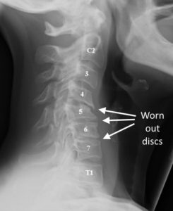 Anterior Cervical Discectomy and Fusion (ACDF) - Drwolgin