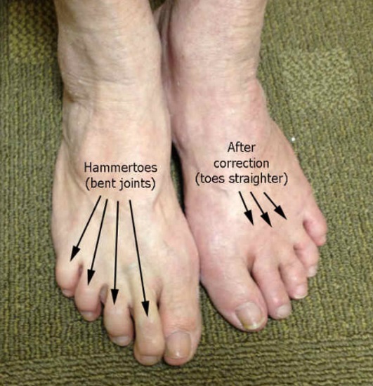 shoes to correct hammer toe