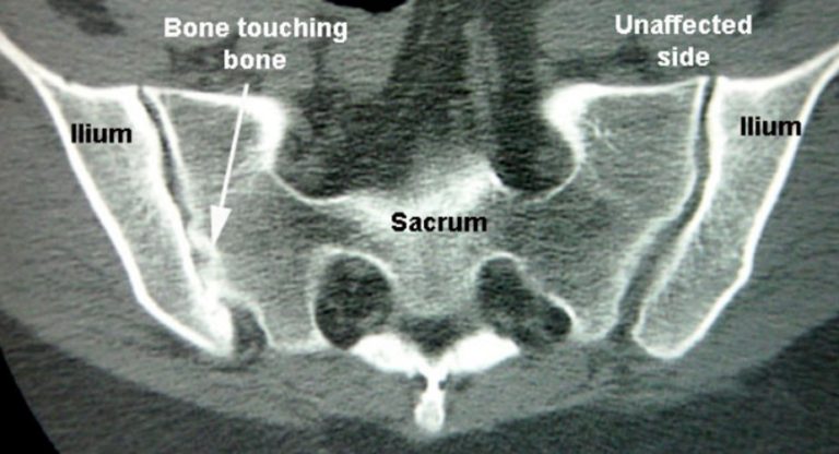 SI Joint Arthritis - Drwolgin