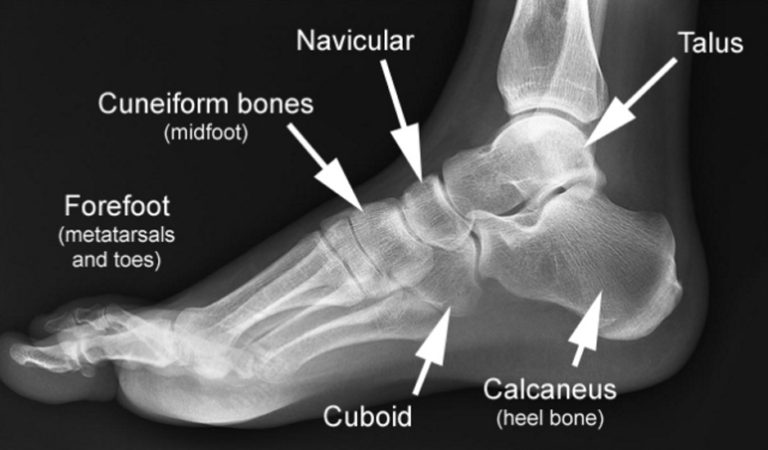 Charcot Fractures - Drwolgin